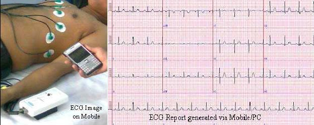 ECG